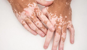 मछली खाने के बाद दूध पीना चाहिए कि नहीं? vitiligo